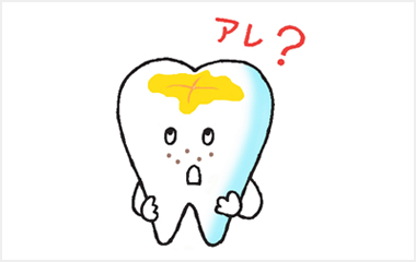 虫歯の進行段階