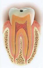 虫歯の段階 C1