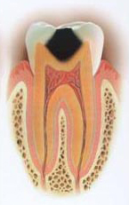 虫歯の段階 C2
