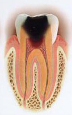 虫歯の段階 C3