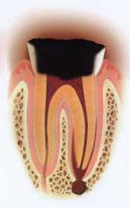 虫歯の段階 C4