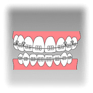 元の歯を生かす矯正治療、セラミックをかぶせる歯冠修復があります