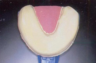 2.石膏を流し固めます。