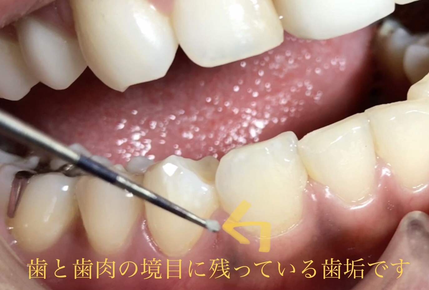 プラーク