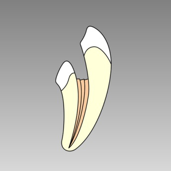 根の治療